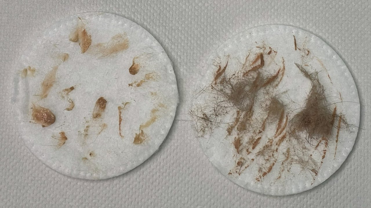 Cotton pads after deep cleansing and dermaplaning at BeCammo, Malta