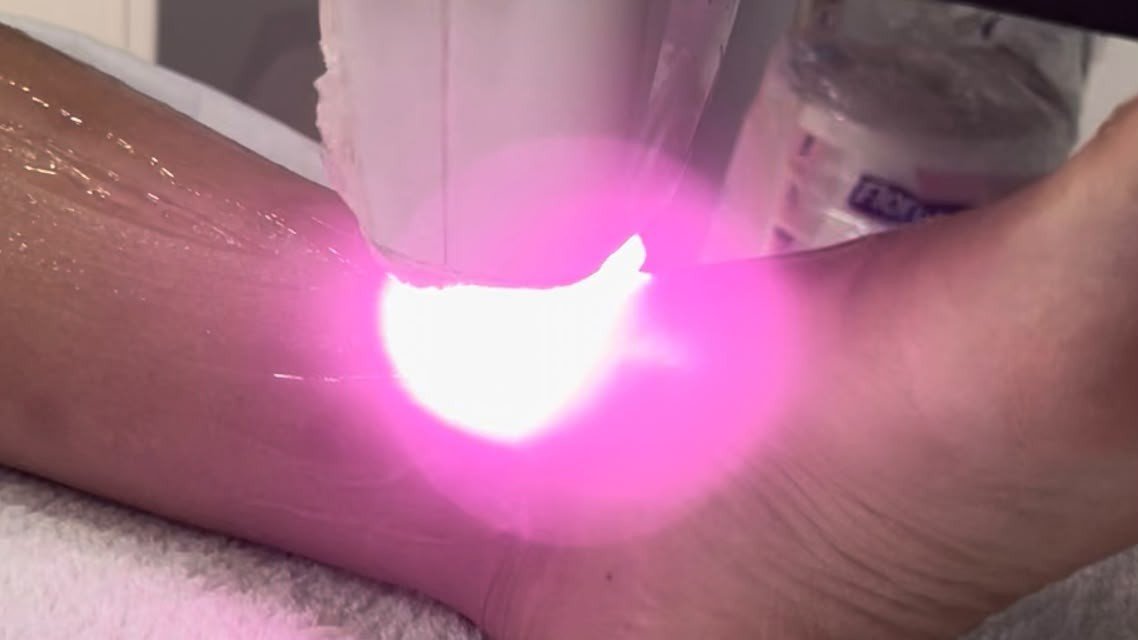 Laser hair removal on the lower leg at BeCammo, Malta