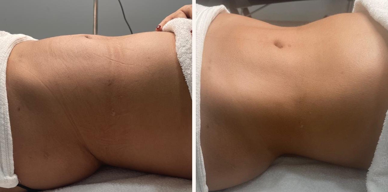 Abdomen before and after massage at BeCammo, Sliema
